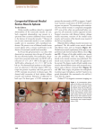 Congenital Bilateral Medial Rectus Muscle Aplasia