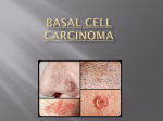 Basal Cell Carcinoma Presentation
