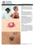 Skin Cancer Overview This is the most common form of cancer. It