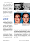 zygomatic fractures - Erlanger Health System