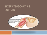 Other signs of a torn biceps tendon can include