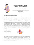 AV NODE ABLATION FOR ATRIAL FIBRILLATION