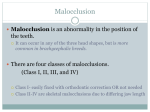 Class III: Mandibular Mesiocclussion