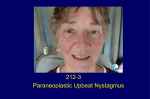 Paraneoplastic Upbeat Nystagmus Therapy