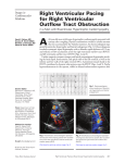 Right Ventricular Pacing for Right Ventricular Outflow Tract Obstruction