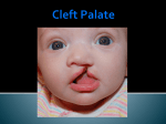 Cleft Palate - PMWestAnatomy