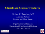 Clavicle and Scapula Fractures