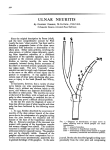 ulnar neuritis