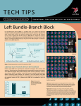 Left Bundle-Branch Block