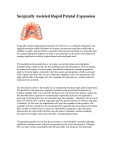 Surgically Assisted Rapid Palatal Expansion