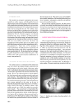 Axillary Cannulation in Cardiopulmonary Bypass for Thoracic Aorta