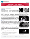 Thrombus or Tumor?