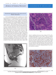 Small-Cell Carcinoma