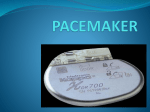 pacemaker - 123SeminarsOnly.com