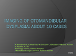 Imaging OF OTOMANDIBULAR DYSPLASIA: ABOUT 10 CASES