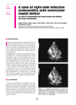 A case of right-side infective endocarditis with ventricular septal defect