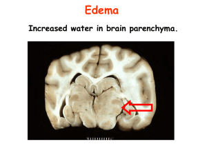 Cerebral Herniation Complication of Intracranial Hypertension