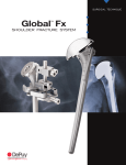Global Fx - THE Shoulder Fracture System