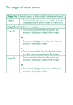 The stages of breast cancer