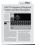 CBCT evaluation of Impacted Canines and root resorption