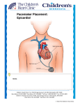 Pacemaker Placement: Epicardial