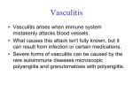 Vasculitis