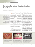 Correction of an Anterior Crossbite with a Fixed Partial Denture