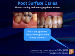 Root Surface Caries - Wellington Branch of the NZDA