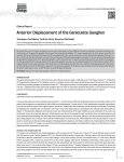 Anterior Displacement of the Geniculate Ganglion