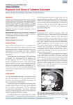 Ruptured Left Sinus of Valsalva Aneurysm