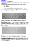 Where are the P waves?