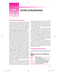 Atrial arrhythmias