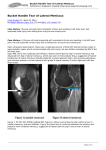 Bucket Handle Tear of Lateral Meniscus