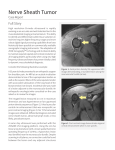 Nerve Sheath Tumor - ZONARE Medical Systems