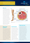 Chronic Exertional Compartment Syndrome CECS