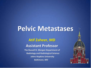 Pelvic Metastases