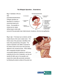 The Whipple Operation – Illustrations