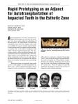 Rapid Prototyping as an Adjunct for Autotransplantation of Impacted