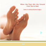 About Bunion Surgery