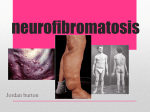 neurofibromatosis - shsbiogeneticdisorders