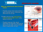 Prostate Cancer Presentation