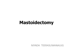 Mastoidectomy