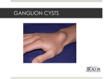 GANGLION CYSTS