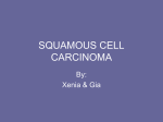 squamous cell carcinoma