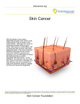 Skin Cancer - Understand.com