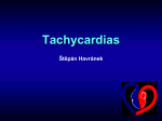 Ventricular tachycardia