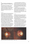 Sir, Carotid-ophthalmic artery aneurysms are a rare but