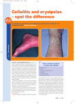 Cellulitis and erysipelas – spot the difference