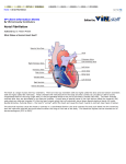 Atrial Fibrillation