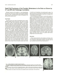 Small-Cell Carcinoma of the Prostate: Metastases to the Brain as